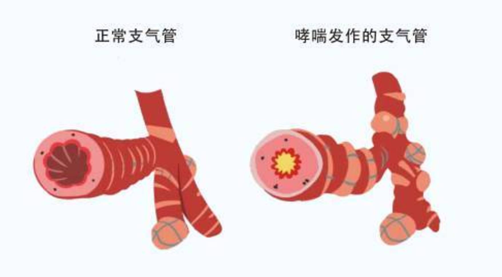 哮喘 (5).jpg