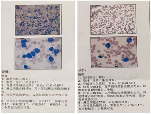 骨髓增生