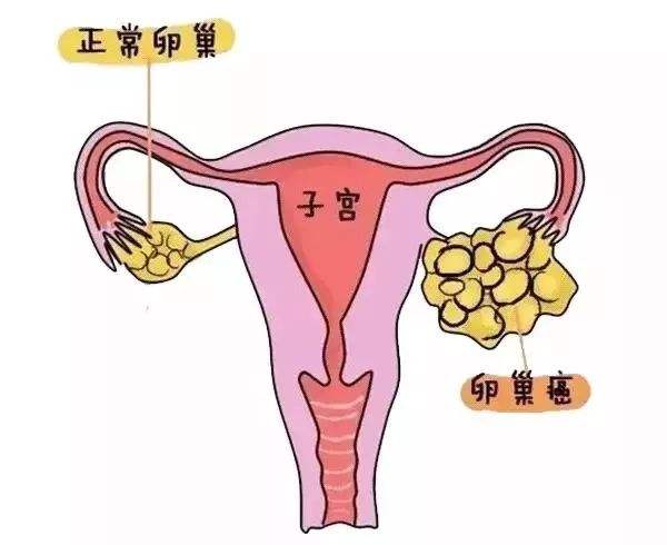 卵巢癌 (13).jpg