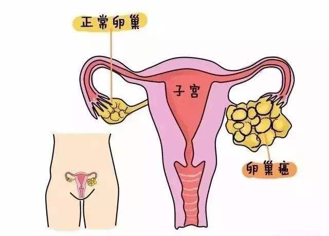 卵巢癌 (1).jpg