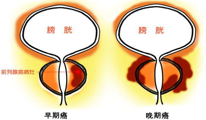 前列腺癌ww.jpg