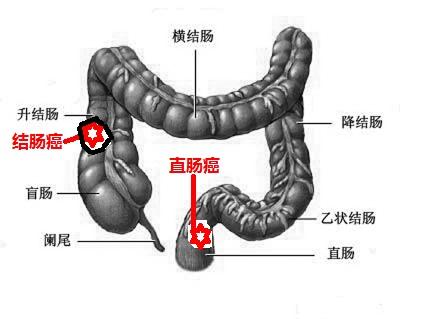 结直肠癌 (3).jpg