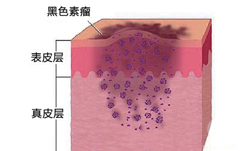 黑色素瘤4.jpg